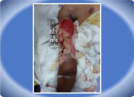 UPPER LIMB INJURY
